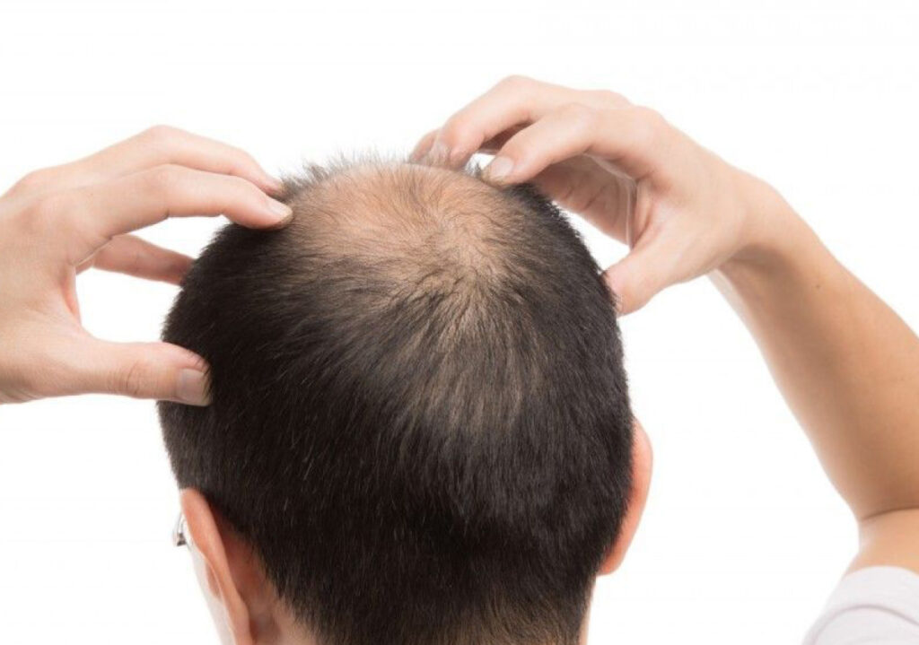 Saç tökülməsinin əsas səbəbləri BUNLAR İMİŞ