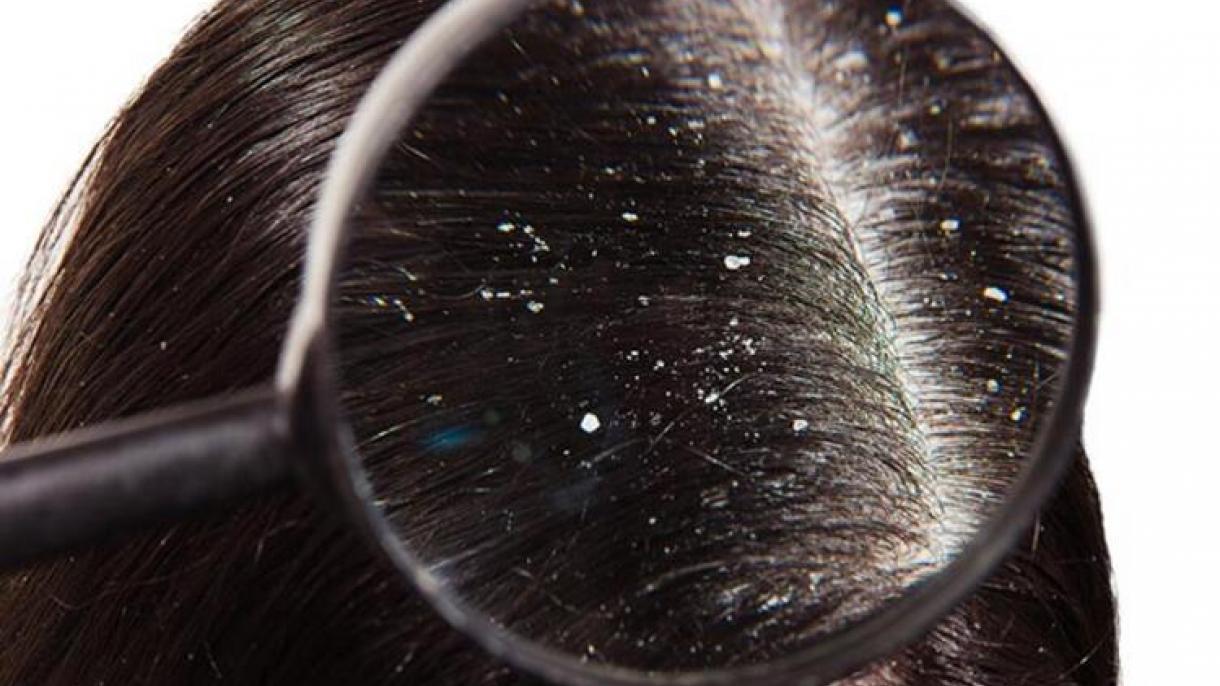 Saçda kəpəyə son qoyan təbii vasitələr