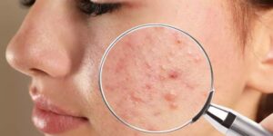 Sızanaqlardan bu təbii vasitələr sayəsində XİLAS OLUN