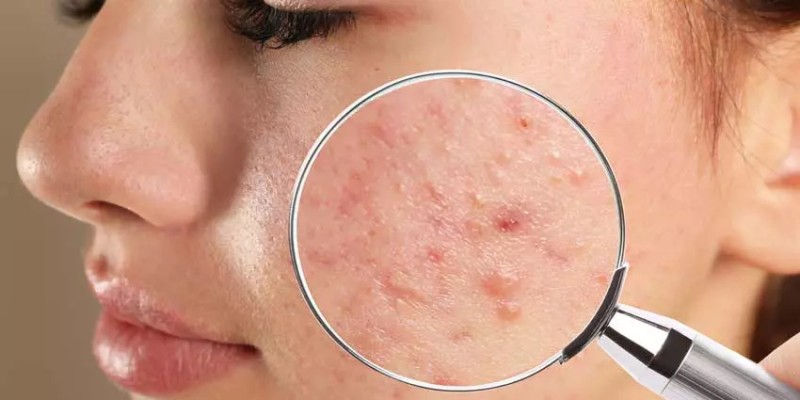 Sızanaqlardan bu təbii vasitələr sayəsində XİLAS OLUN